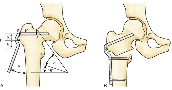 Proximal femur osteotomy
