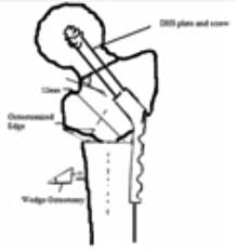 Proximal femur osteotomy technique