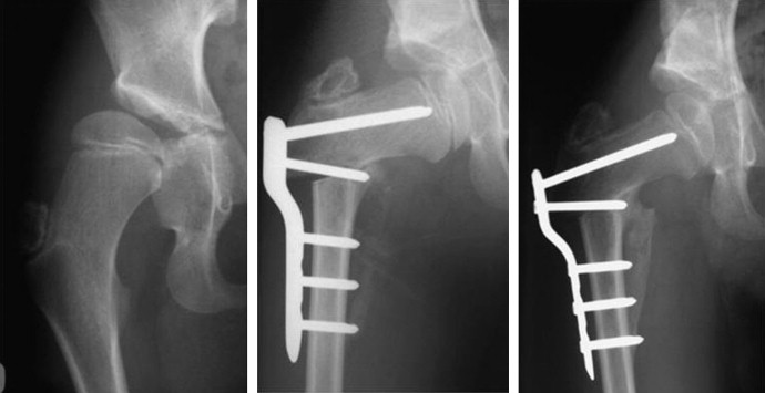 Proximal femur osteotomy result