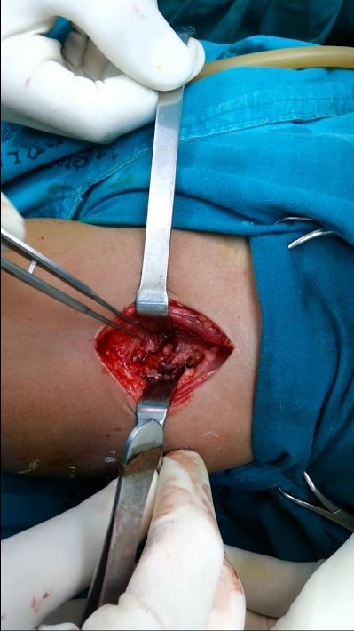 Open arthrotomy for septic hip