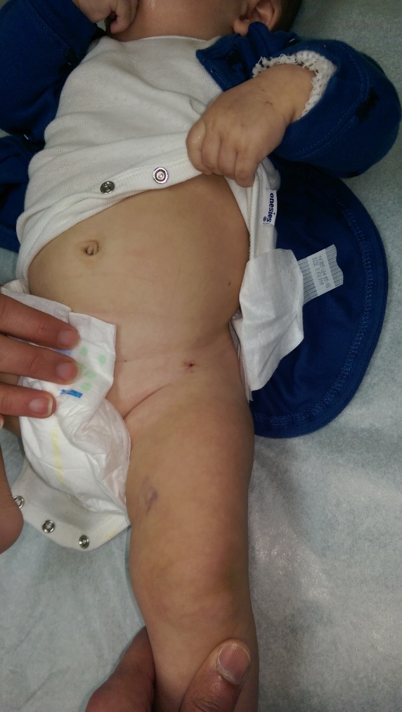 Single portal arthroscopy for septic hip