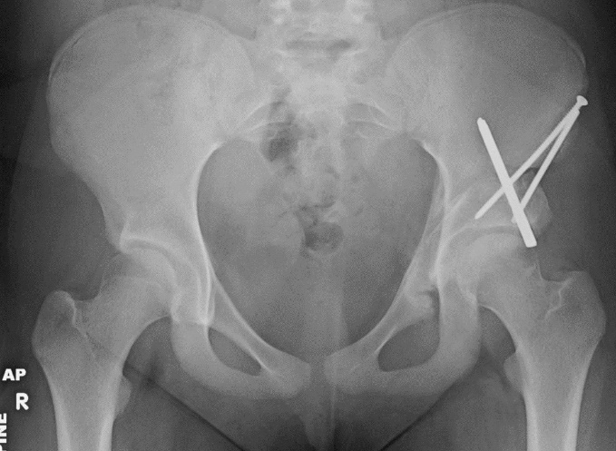 Triple osteotomy — radiograph