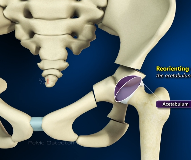 PAO — periacetabular osteotomy
