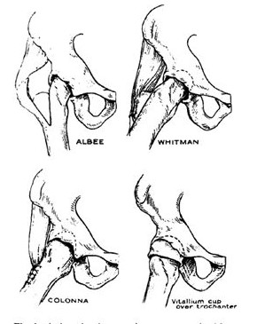 Trochanteric arthroplasty